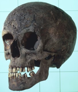 Female syphilitic skull with multiple erosive lesions. Artist: Unknown