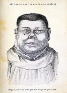 Cretin aged 15, c1890. Artist: Unknown
