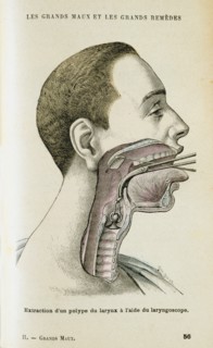 Using a laryngoscope to aid the removal of a polyp from the throat, c1890. Artist: Unknown