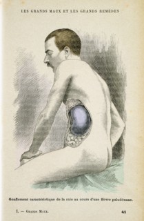 Typical enlarged spleen of a Malaria patient, c1890. Artist: Unknown