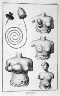 Breast surgery, 1751-1777. Artist: Unknown