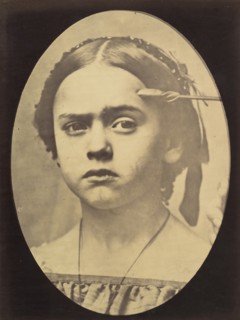 Figure 10: Showing the expressive lines of m. frontalis in a young girl , 1854-56, printed 1862.