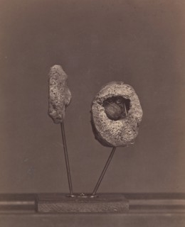 Excised Knee Joint. A Round Musket Ball in the Inner Condyle of the Right Femur [Gardiner Lewis, Company B, Nineteenth Indiana Volunteers], 1866-67.