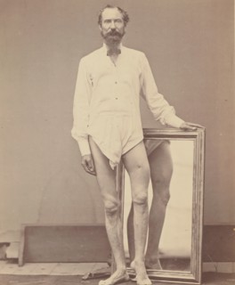 Gunshot Wound of Middle Third of Left Femur, 1865-67.