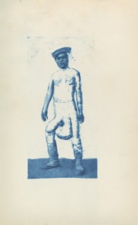 Elephantiasis, c. 1870s.