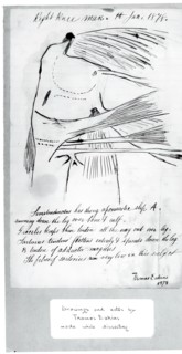 (Untitled) (Anatomical Study Of Right Knee), 1878.