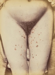 Syphilide, 1871. Creator: Arthur de Montmeja.