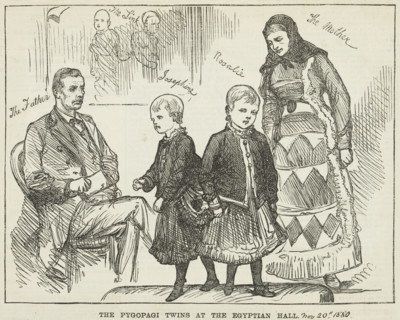 The Pyopagi Twins shown at Egyptian Hall, 1880. Pygopagi twins are conjoined at the buttocks.