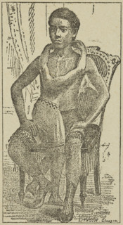 Lalloo, The Greatest Living Wonder on Earth, 1887. Illustration from an advertisement for the