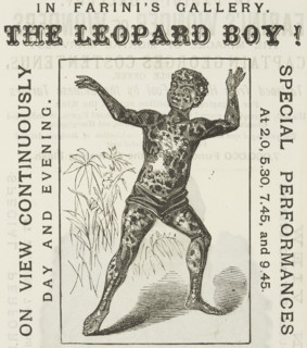The Leopard Boy! in Farini's Gallery, 1881. 'On View Continuously, Day and Evening. Spotted black,