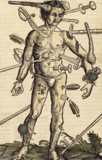 The wound man, 1517. German surgeon Hans von Gersdorff wrote a book with instructions for
