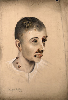 Head of a woman with a severe disease affecting her face and neck, 1864. Creator: Christopher D'Alton.
