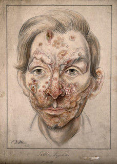 Head of a man with a syphilitic lesions affecting his face, 1874. Creator: Christopher D'Alton.
