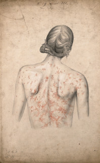 Back of a woman suffering from a rash of sores, 1855. Creator: Christopher D'Alton.