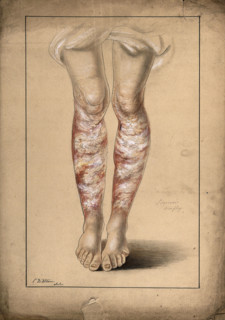 Diseased skin on the legs of a man suffering from psoriasis, 1873. Creator: Christopher D'Alton.