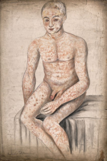 A seated man suffering from a mottled rash of sores, which covers his entire body and face, 1858. Creator: Christopher D'Alton.