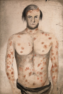 The face, arms and torso of a man suffering from diseased skin and abcesses (?), between 1800 & 1899 Creator: Christopher D'Alton.