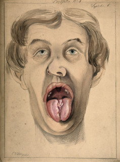 The face of a man suffering from syphilis, shown with mouth open wide, displaying areas of..., 1869. Creator: Christopher D'Alton.