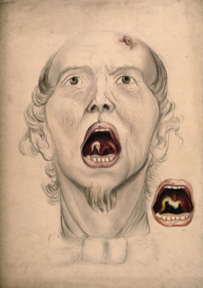 The face of a man, with mouth open wide, displaying a diseased area of tissue on the soft..., 1866. Creator: Christopher D'Alton.