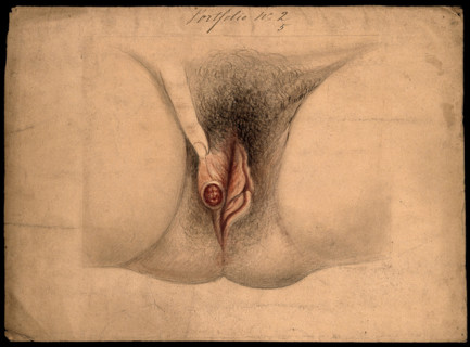 Female genitalia held open by a finger to show an area of diseased tissue, (18)66. Creator: Christopher D'Alton.