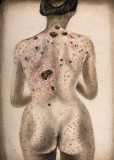 The back, buttocks and arms of a woman, displaying areas of diseased tissue..., (1840/1870?). Creator: Christopher D'Alton.