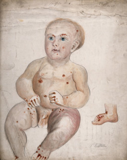 A three month old baby boy with diseased skin and sores on his face and body..., between 1800 & 1899 Creator: Christopher D'Alton.