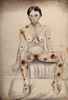 A seated woman displaying areas of diseased tissue on her entire body, face, genitals and eye, 1858. Creator: Christopher D'Alton.