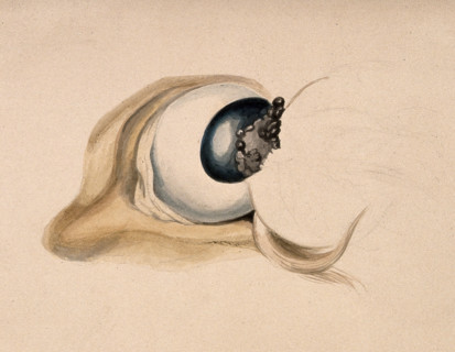 A diseased eye. Creator: Unknown.