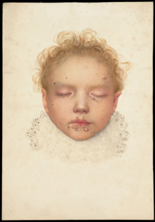 Head of a child with closed eyes and skin disease on the face, 1892. Creator: Unknown.