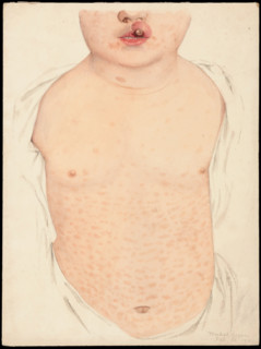 A boy with a congenital deformity of the mouth and a rash on the trunk, Feb 16th 1901. Creator: Mabel Green.