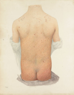 Back of a boy with skin disease, 1891. Creator: W Toogood Hill.