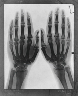 Two hands, viewed through x-ray, 1896.