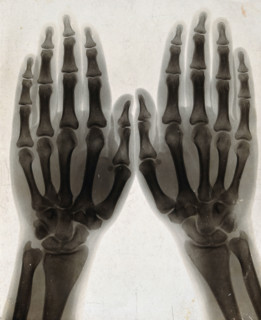 Two hands, viewed through x-ray, 1896.