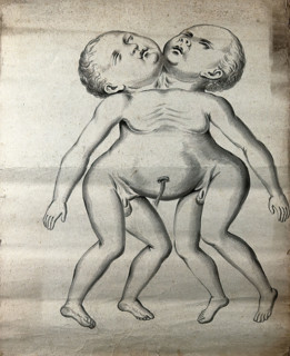 Male conjoined twins joined at the neck and chest; anterior view, 1900. Creator: Unknown.