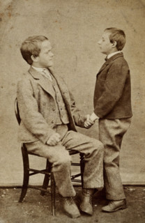 Down's syndrome: in two young men holding hands, one sitting and one standing, c1880s. Creator: Unknown.