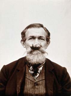 A patient of Léon Desguin, before operation, c1890s. Creator: Unknown.