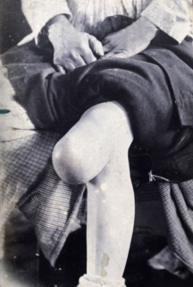 Friern Hospital, London: the knee of a seated person, with a large growth,  1890-1910. Creator: Unknown.