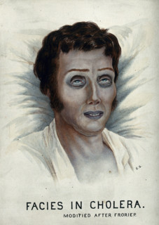 A cholera victim with a typical facial appearance, 1920-1950. Creator: Unknown.