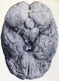 Friern Hospital, London: a brain, 1890-1910. Creator: Unknown.