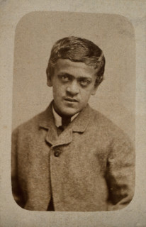 A young man, probably showing some signs of Down's syndrome, c1880s. Creator: Davis & Sons.