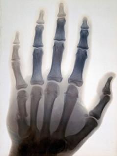 Sir Gervas Powell Glyn, 6th Bart: radiograph of his hand, 1896. Creator: Sir GP Glyn.