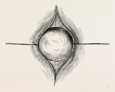 mode of exposing a tumour by ligature or threat retractors, medical equipment, surgical instrument,
