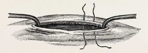 method of steadying the margins of a wound with blunt hooks, medical equipment, surgical