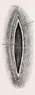 ligatuite of the right radial, medical equipment, surgical instrument, history of medicine