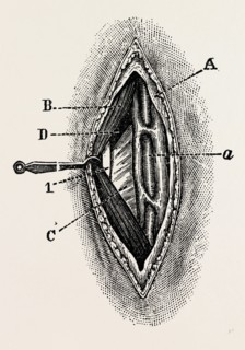 ligatuite of the right radial, medical equipment, surgical instrument, history of medicine