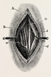 ligature, medical equipment, surgical instrument, history of medicine