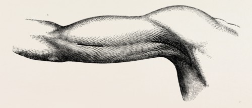 ligature of the brachial about the middle of the arm, medical equipment, surgical instrument,