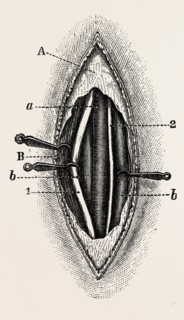 ligature of the right finger, medical equipment, surgical instrument, history of medicine