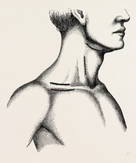 ligature of the first part, medical equipment, surgical instrument, history of medicine