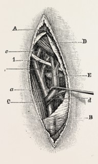 ligature, medical equipment, surgical instrument, history of medicine